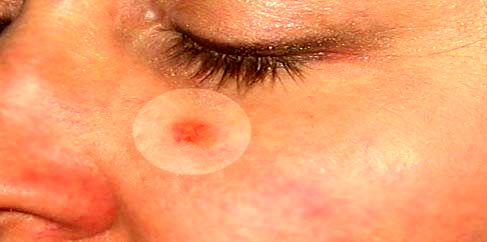 هر تورم غیرمعمول در نواحی سر و صورت با ماندگاری بیش از سه ماه از علائم بروز سرطان است