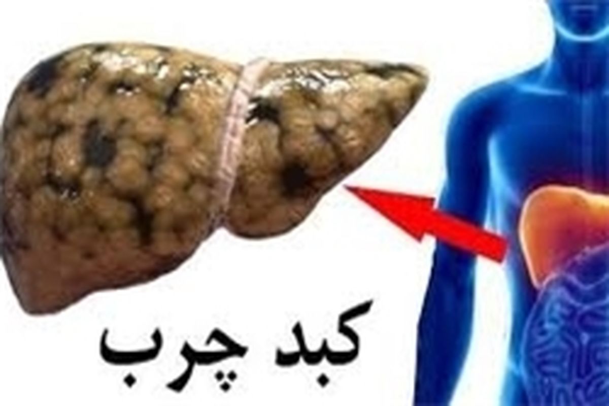 کبد چرب