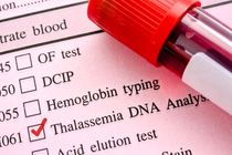 اعلام آمادگی دانشگاه علوم پزشکی گیلان برای راه اندازی اولین مرکز جامع خدمات بیماران تالاسمی