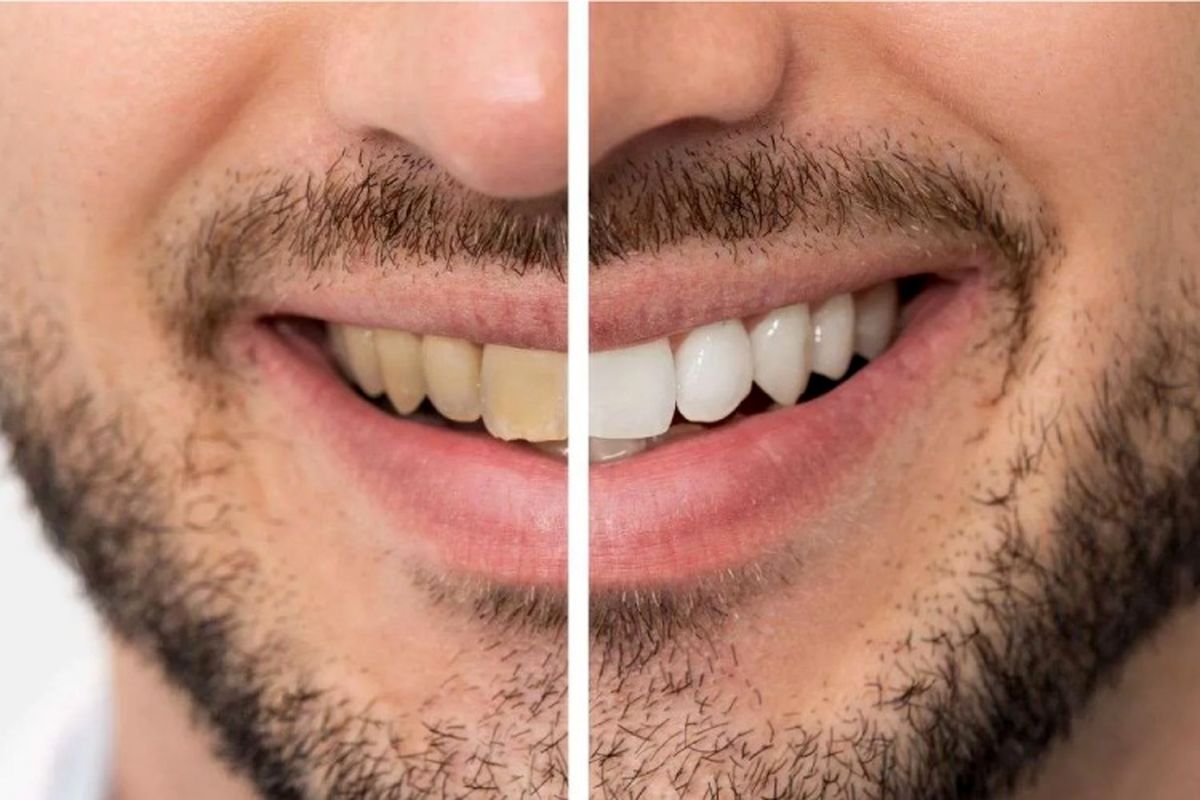 لمینت دندان