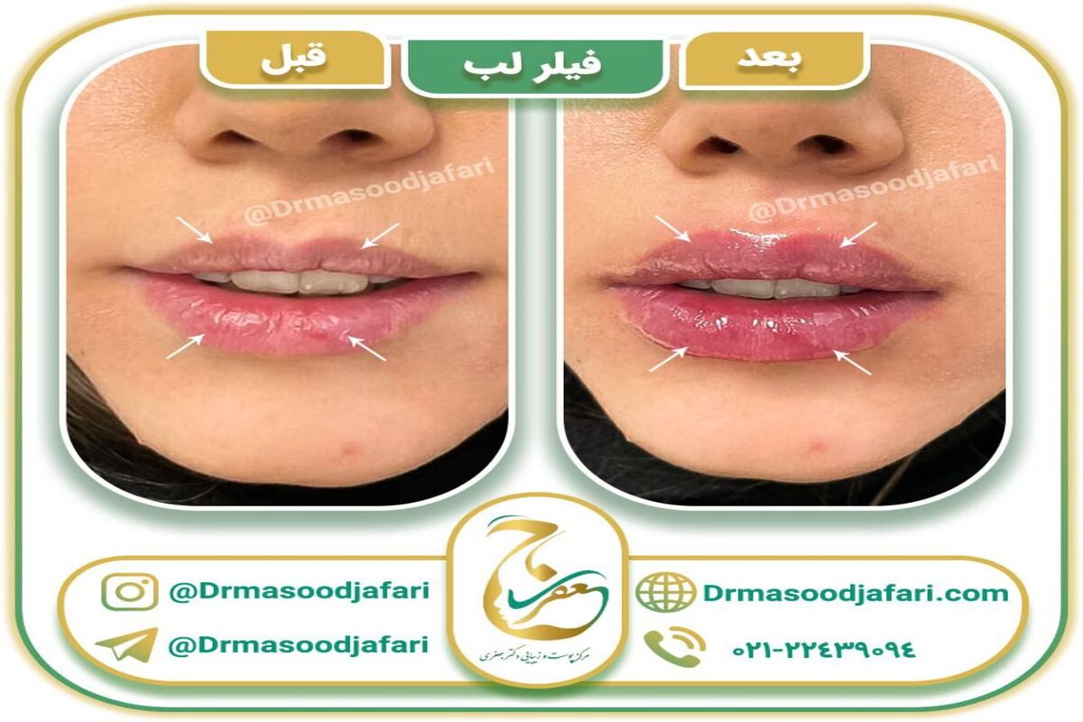 فیلر