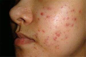 رابطه لک و جوش‌های پوستی با خواب