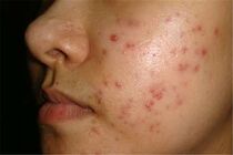 رابطه لک و جوش‌های پوستی با خواب