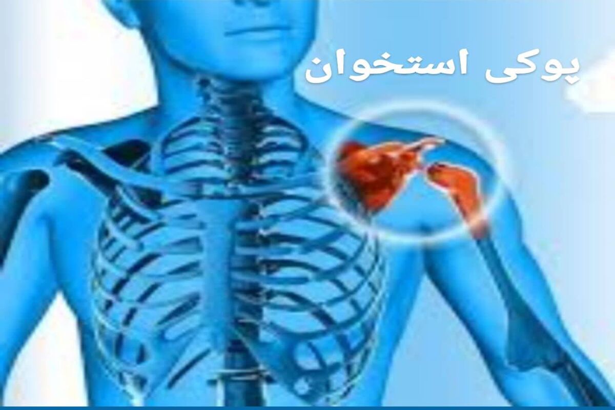 پوکی استخوان