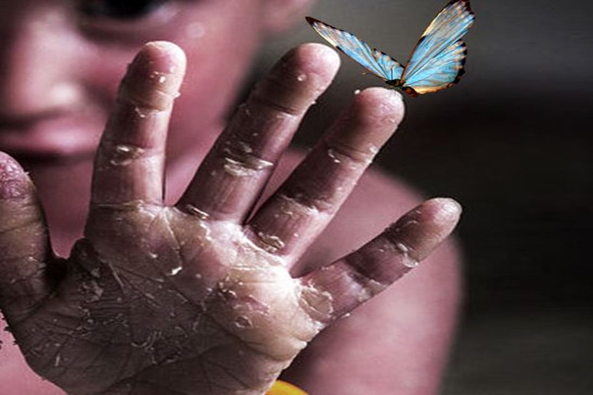 بیماران پروانه‌ای 