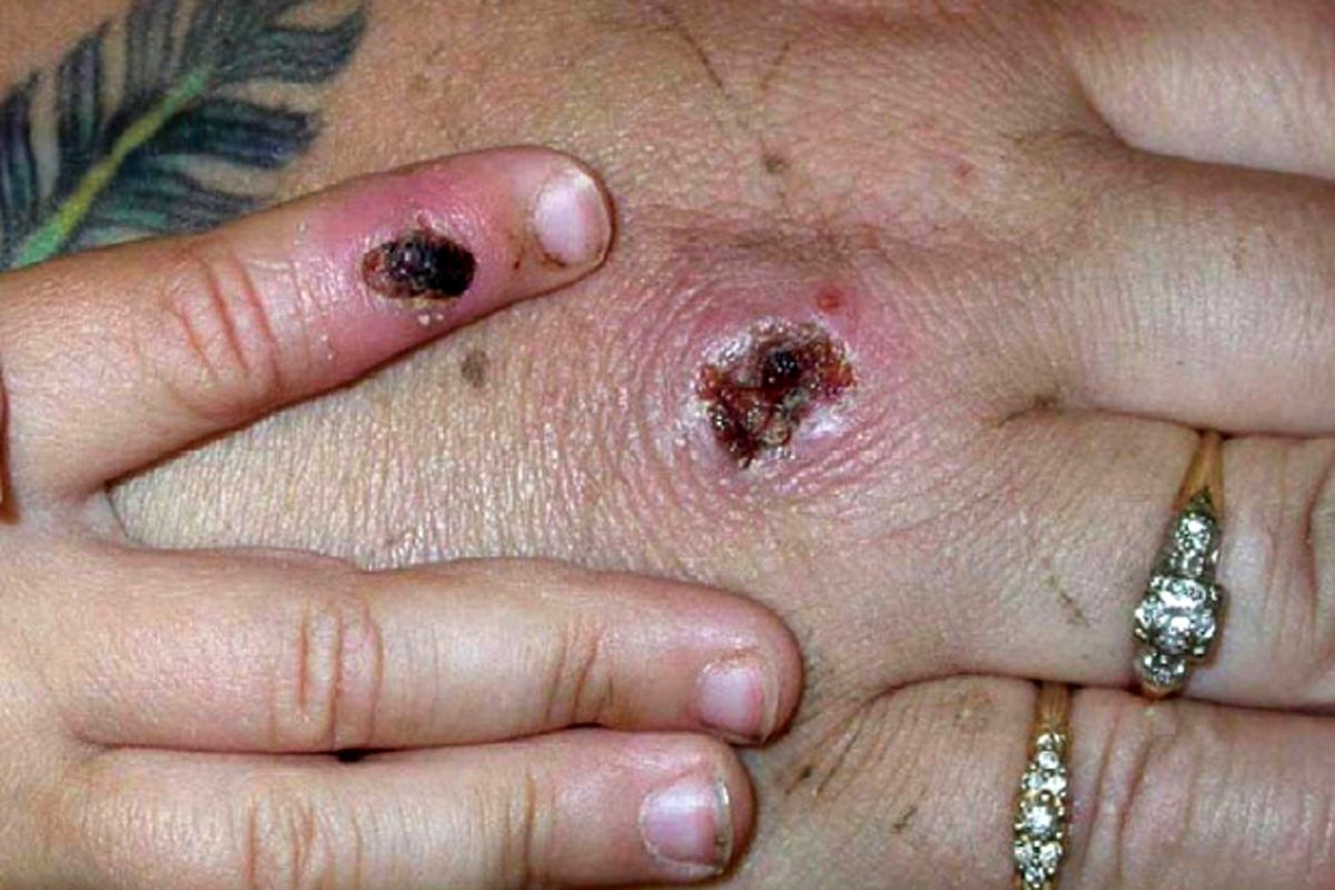 بیماری آبله میمون