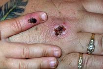 شناسایی اولین مورد ابتلا به آبله میمون در امارات متحده