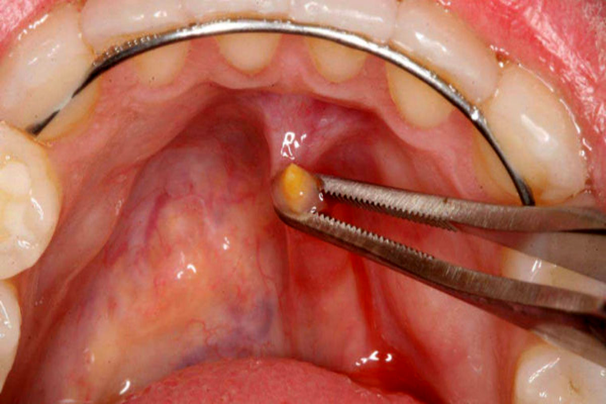 تومور غدد بزاقی