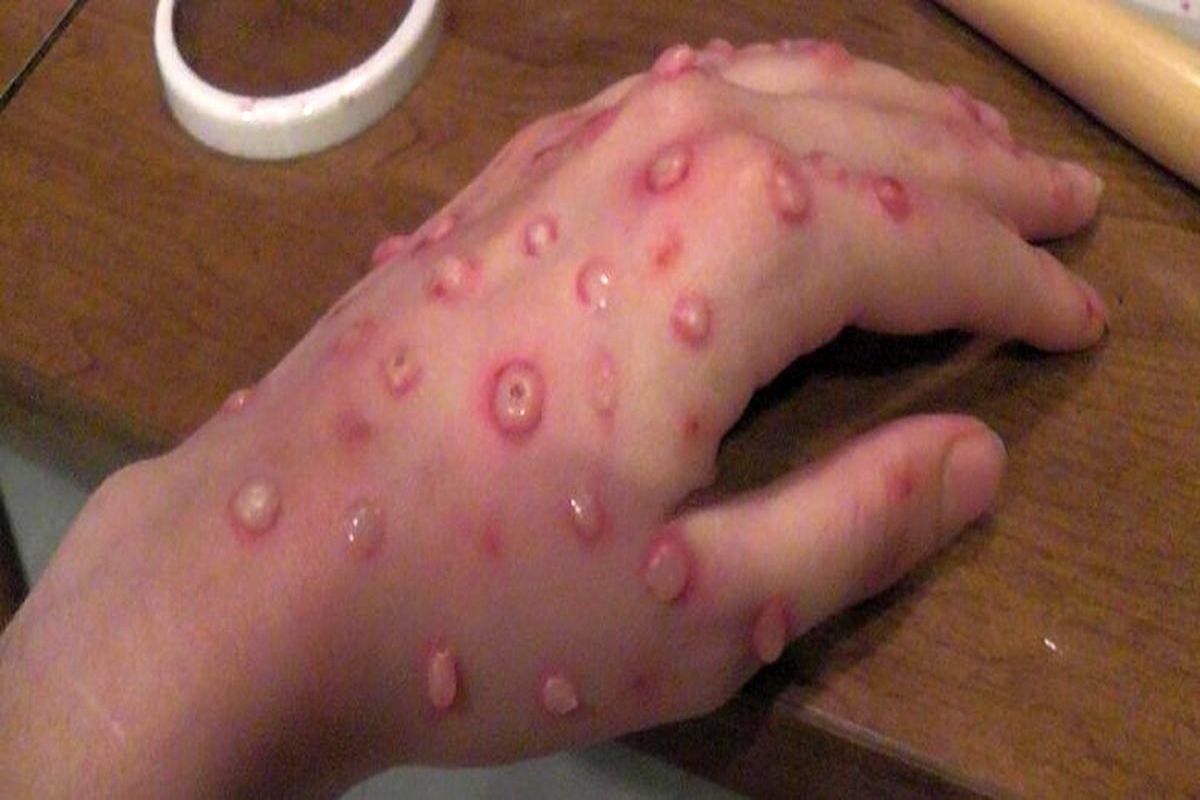 آبله میمونی