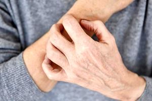 اگزما چیست و چه علائمی دارد؟