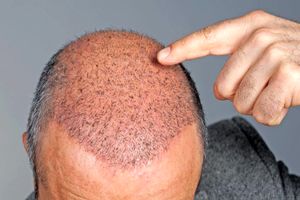 مزایا و معایب کاشت مو/کاشت مو، بهترین راه درمان و ترمیم مو!؟