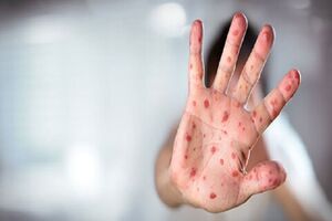 آمار سرخک در استرالیا افزایش نگران‌کننده داشته است
