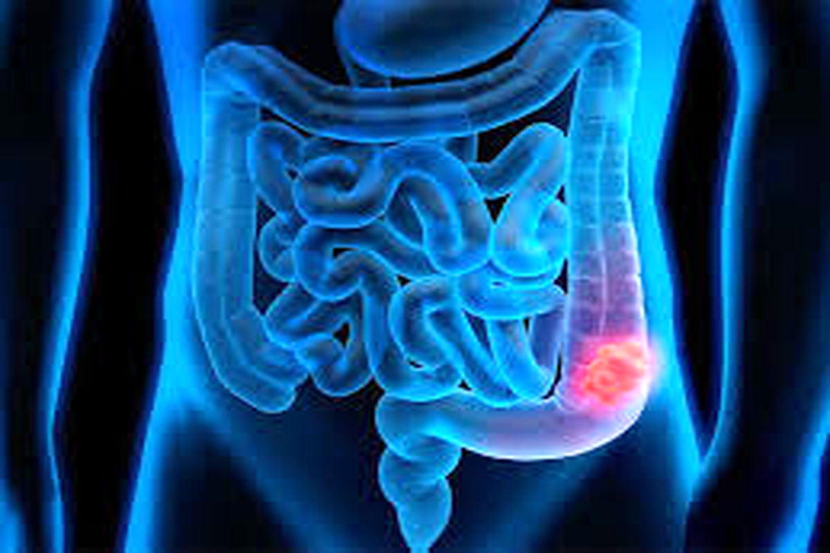 سرطان روده بزرگ