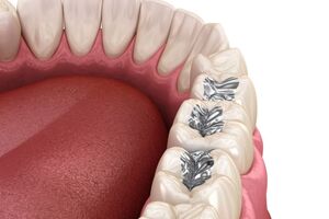 پر کردن دندان با مواد سفید یا سیاه؛ کدام گزینه مناسب‌تر است؟