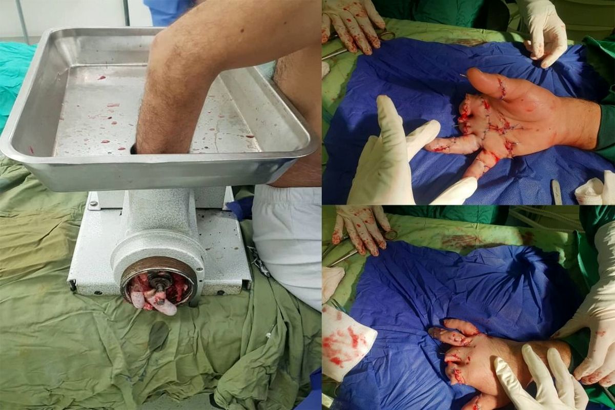 پیوند انگشت