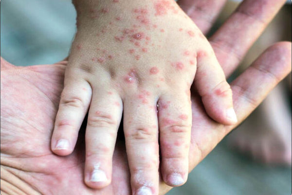 سازمان جهانی بهداشت ریشه کنی سرخک و سرخجه در ایران را تایید کرد