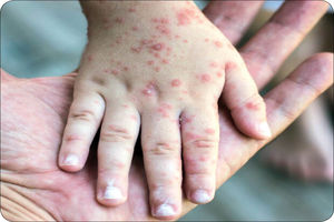 شناسایی ۷۰ مبتلا به سرخک در هرمزگان