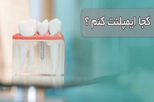 کجا ایمپلنت کنم ؟ (اهمیت مرکز ایمپلنت تخصصی )