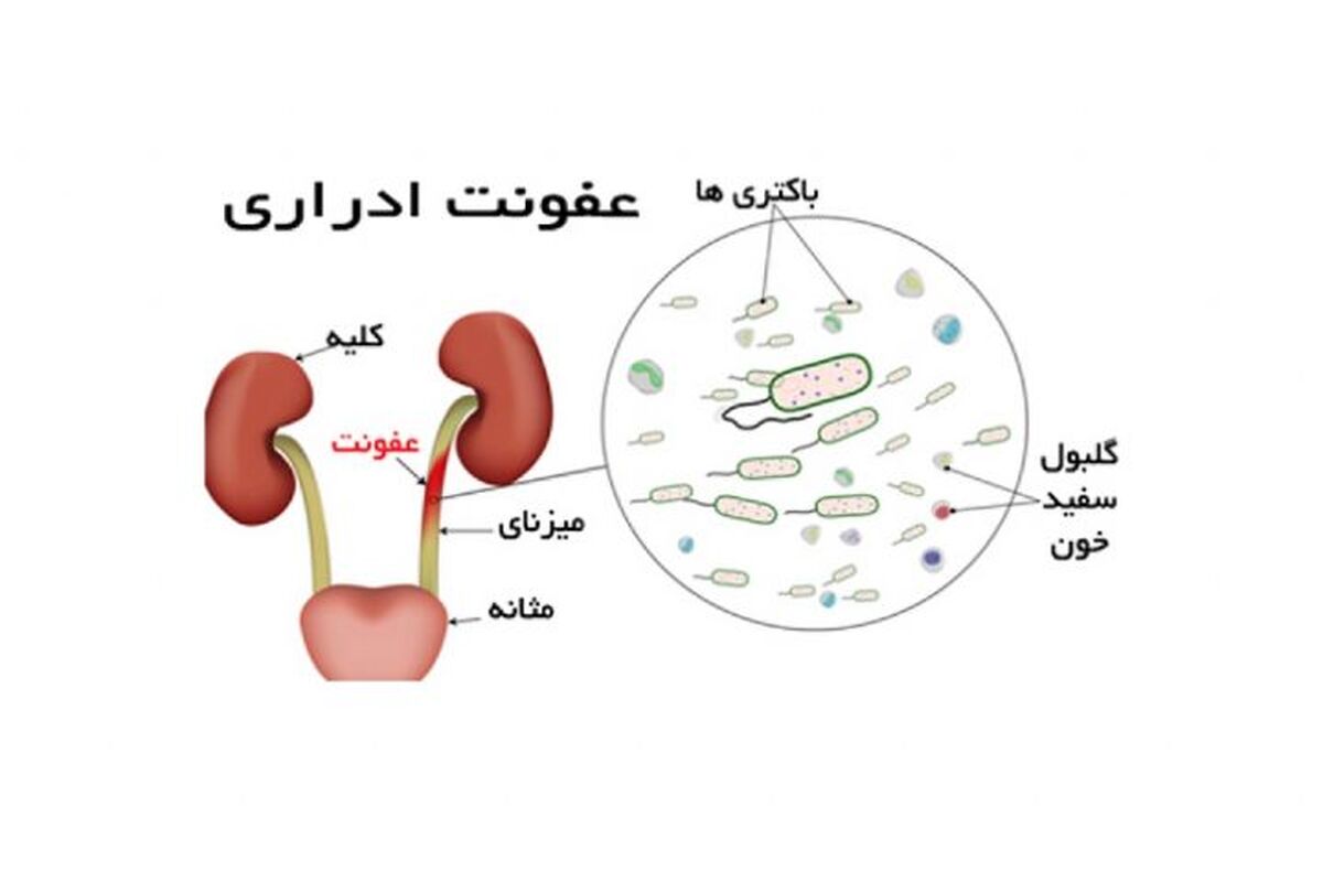 عفونت ادراری