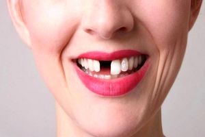 تعبیر دیدن افتادن دندان در خواب چیست؟ / تعبیر خواب افتادن دندان