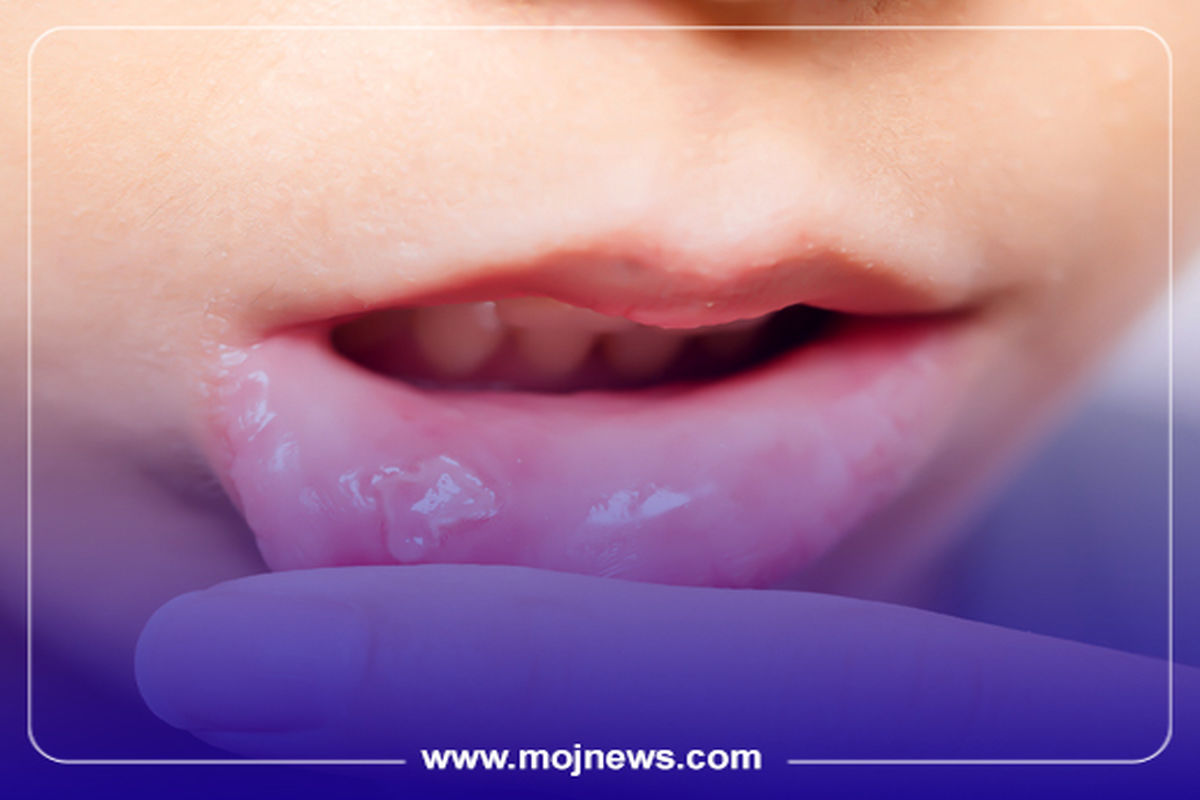 کاور اینفو آفت دهانی موج