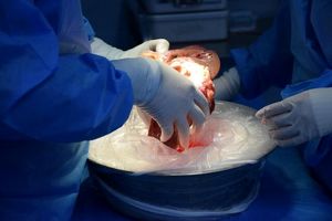 عمل موفقیت‌آمیز دو پیوند کبد در بیمارستان امام رضا(ع) تبریز