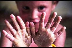 رئیس سازمان غذا و دارو: 550 فرد مبتلا بیماری پروانه ای در کشور شناسایی  شدند