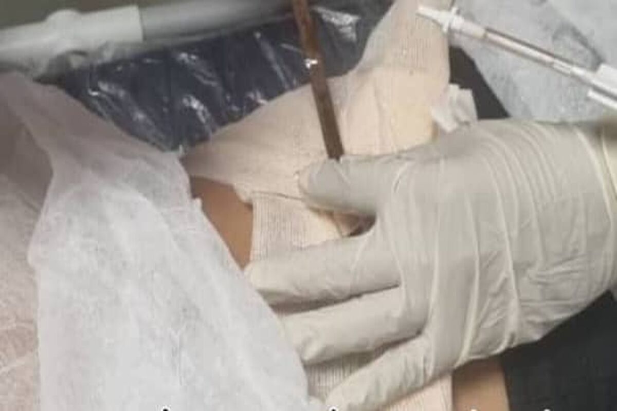 فرو رفتن جسم نوک‌تیز در بدن یک شهروند