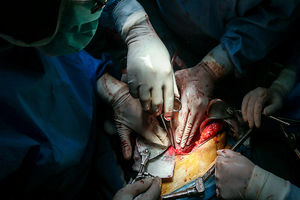 انجام ششمین پیوند موفقیت آمیز کبد در شمال کشور