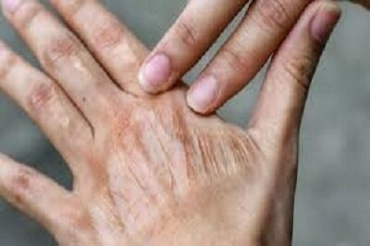 پیری پوست