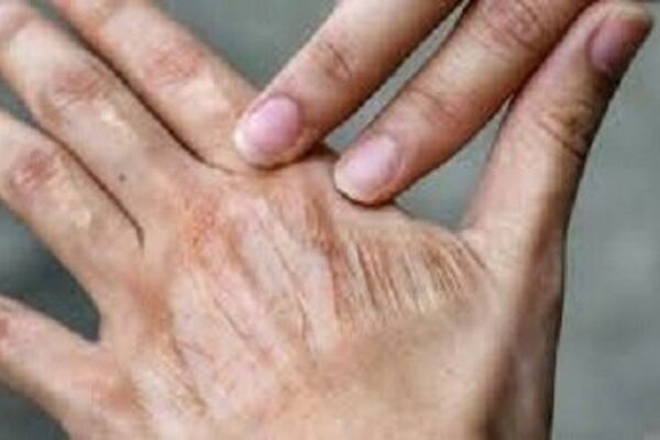 آلودگی هوا بر سلامت و پیری پوست تأثیر خاموش دارد