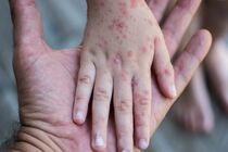 آغاز طرح غربالگری سرخک در هرمزگان