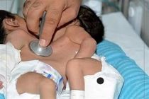 عمل جراحی جداسازی دوقلو های به هم چسبیده اهوازی