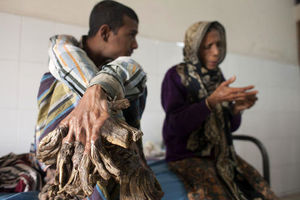 همه چیز درباره بیماری «مرد درختی» + فیلم و عکس