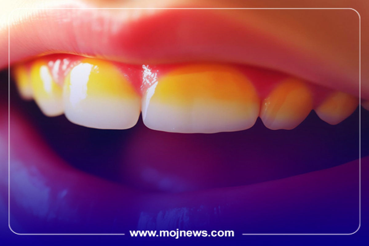 کاور زردی دندان موج