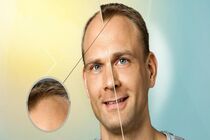 سلول های بنیادی با یکدیگر برای رشد مو همکاری می کنند