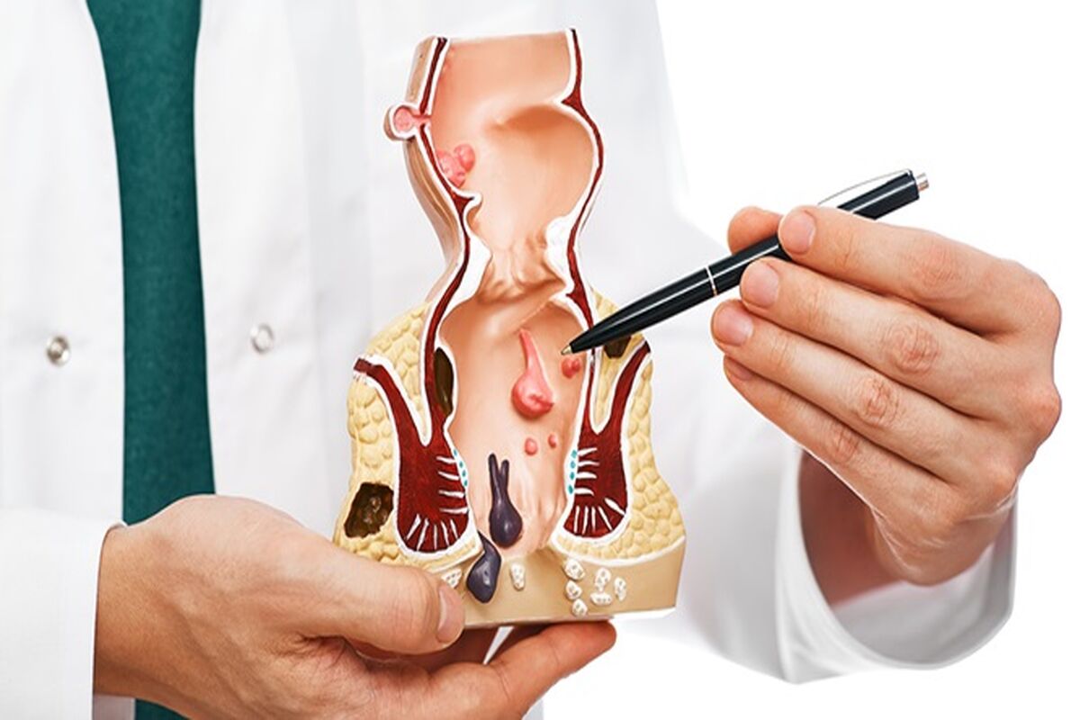 لیزر