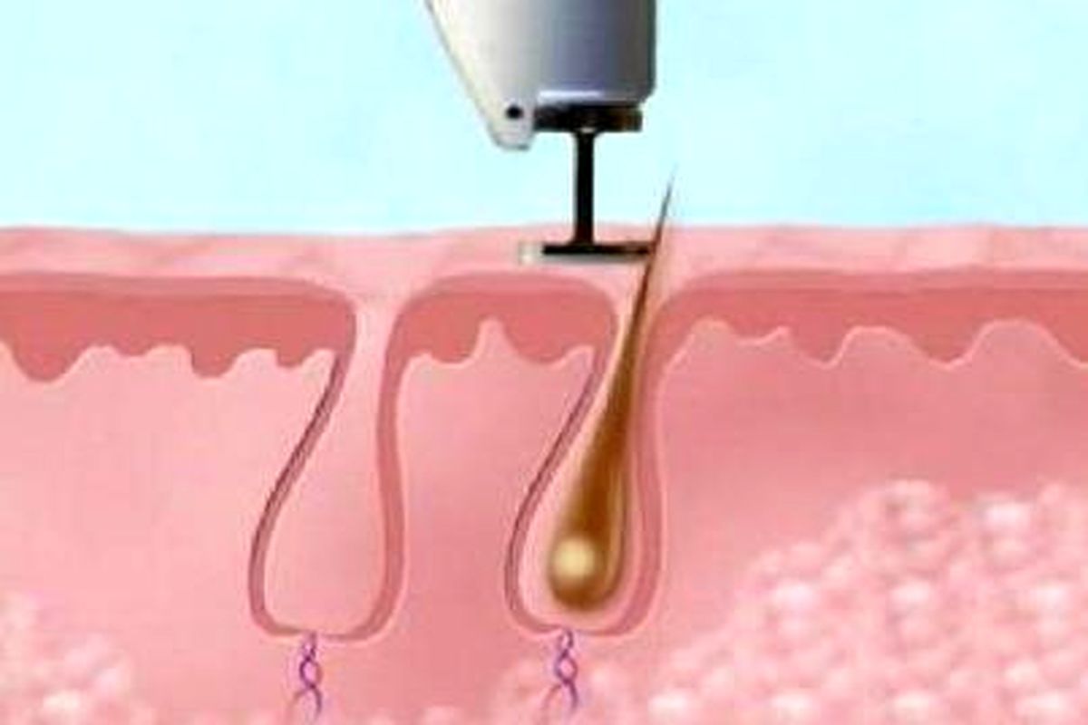 لیزرموهای زائد2