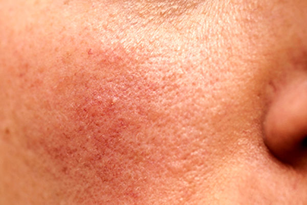 وزارت بهداشت به ورود پزشکان عمومی به حوزه پوست واکنش نشان داد