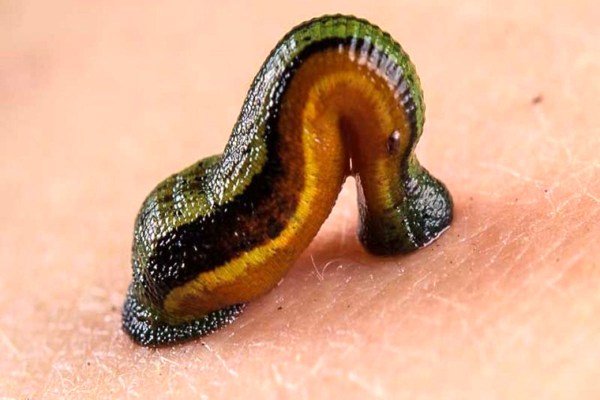 زالو درمانی