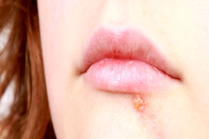 آیا می دانید چرا زخم سرد می زنیم