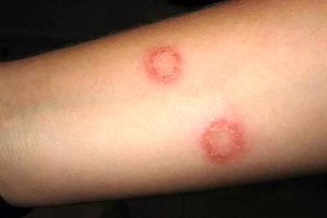 سالک بیماری بومی یزد است 