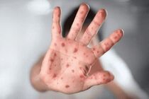 آبله میمون شباهت زیادی به زونا و آبله مرغان دارد